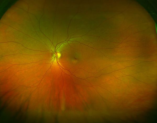 optomap retinal exam article